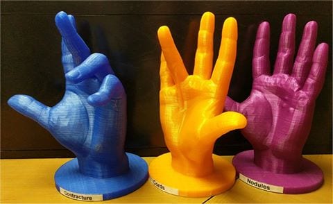 Dupuytren disease, your hands, and research for a cure: Boston